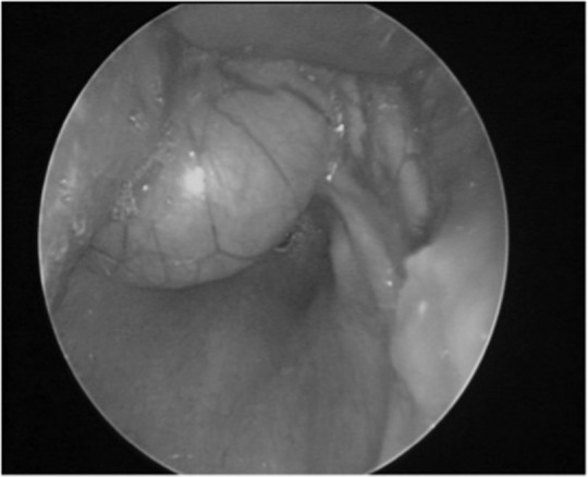 Vallecular cysts: a differential diagnosis to consider for neonatal stridor and failure to thrive.