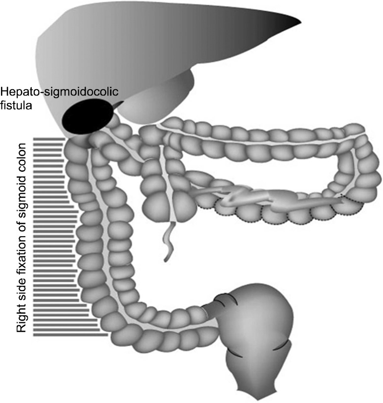 Right side fixation of sigmoid colon with a hepato-sigmoidocolic fistula in patient with hepatocellular carcinoma and midgut malrotation.