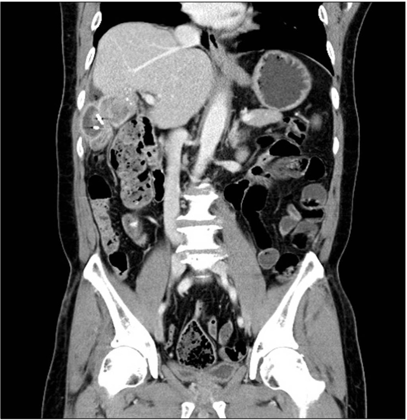 Right side fixation of sigmoid colon with a hepato-sigmoidocolic fistula in patient with hepatocellular carcinoma and midgut malrotation.