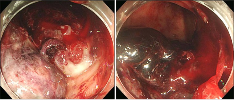 Right side fixation of sigmoid colon with a hepato-sigmoidocolic fistula in patient with hepatocellular carcinoma and midgut malrotation.