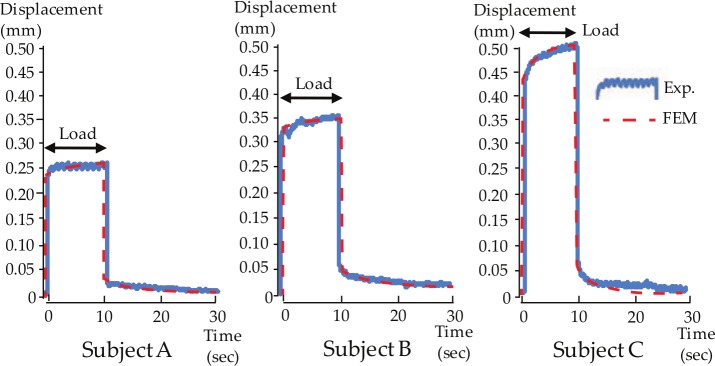 Patient-specific finite element analysis of viscoelastic masticatory mucosa.