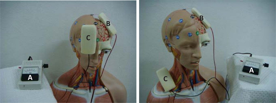 Transcranial Direct Current Stimulation in Neuropathic Pain.