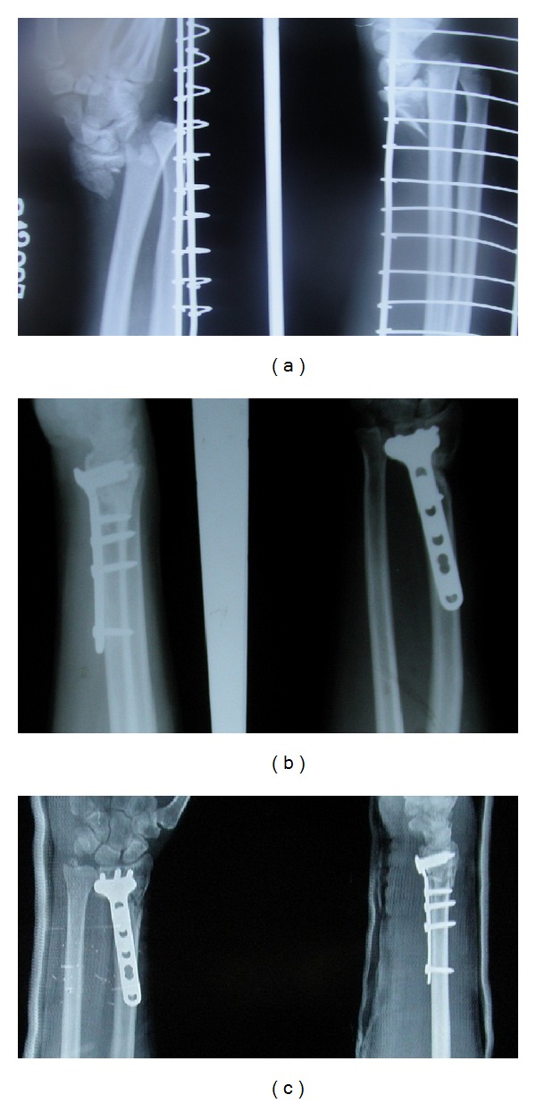 Dorsally comminuted fractures of the distal end of the radius: osteosynthesis with volar fixed angle locking plates.