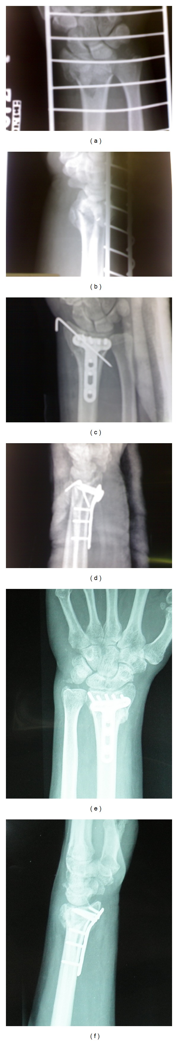 Dorsally comminuted fractures of the distal end of the radius: osteosynthesis with volar fixed angle locking plates.