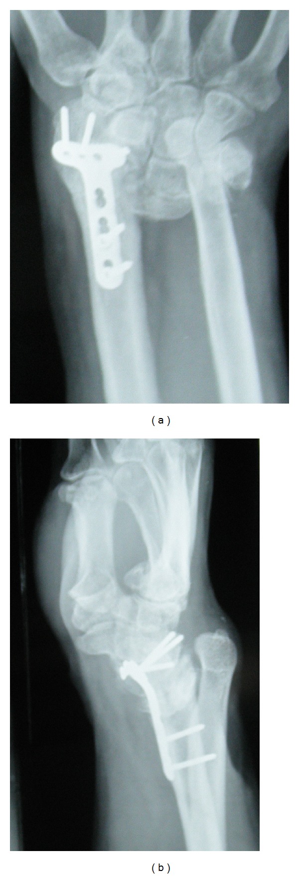 Dorsally comminuted fractures of the distal end of the radius: osteosynthesis with volar fixed angle locking plates.