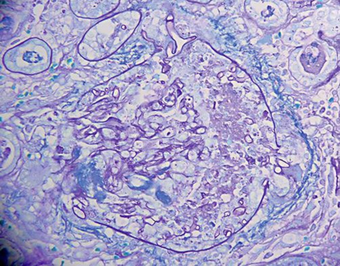 Disseminated mucormycosis in a patient with recent kidney transplantation: a case report and review of the literature.