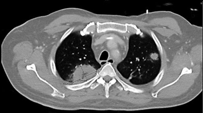 Disseminated mucormycosis in a patient with recent kidney transplantation: a case report and review of the literature.