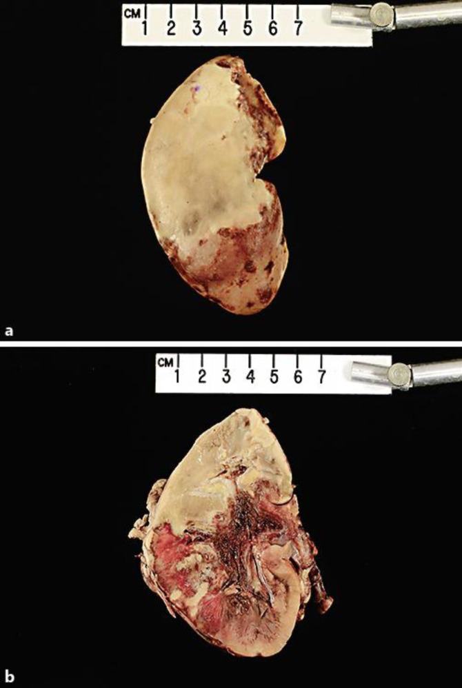 Disseminated mucormycosis in a patient with recent kidney transplantation: a case report and review of the literature.