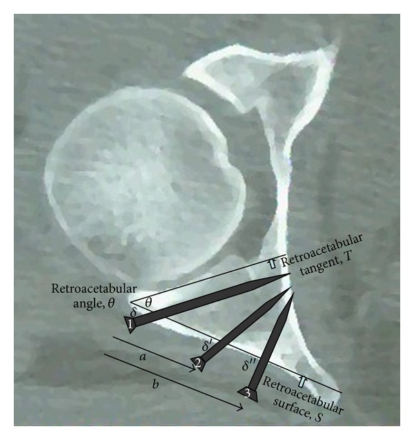 The retroacetabular angle determines the safe angle for screw placement in posterior acetabular fracture fixation.