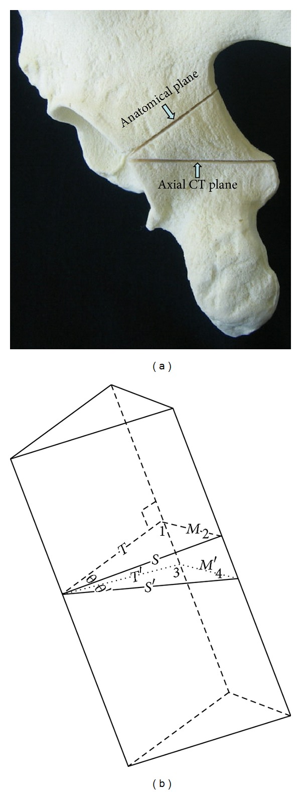 The retroacetabular angle determines the safe angle for screw placement in posterior acetabular fracture fixation.