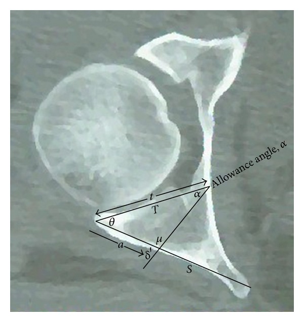 The retroacetabular angle determines the safe angle for screw placement in posterior acetabular fracture fixation.