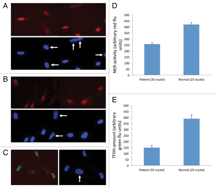 Xeroderma Pigmentosum-Trichothiodystrophy overlap patient with novel XPD/ERCC2 mutation.