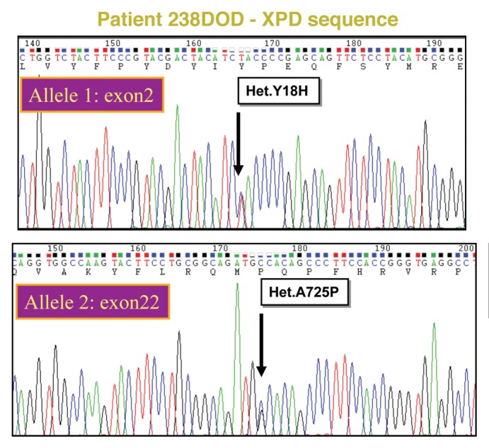 Xeroderma Pigmentosum-Trichothiodystrophy overlap patient with novel XPD/ERCC2 mutation.