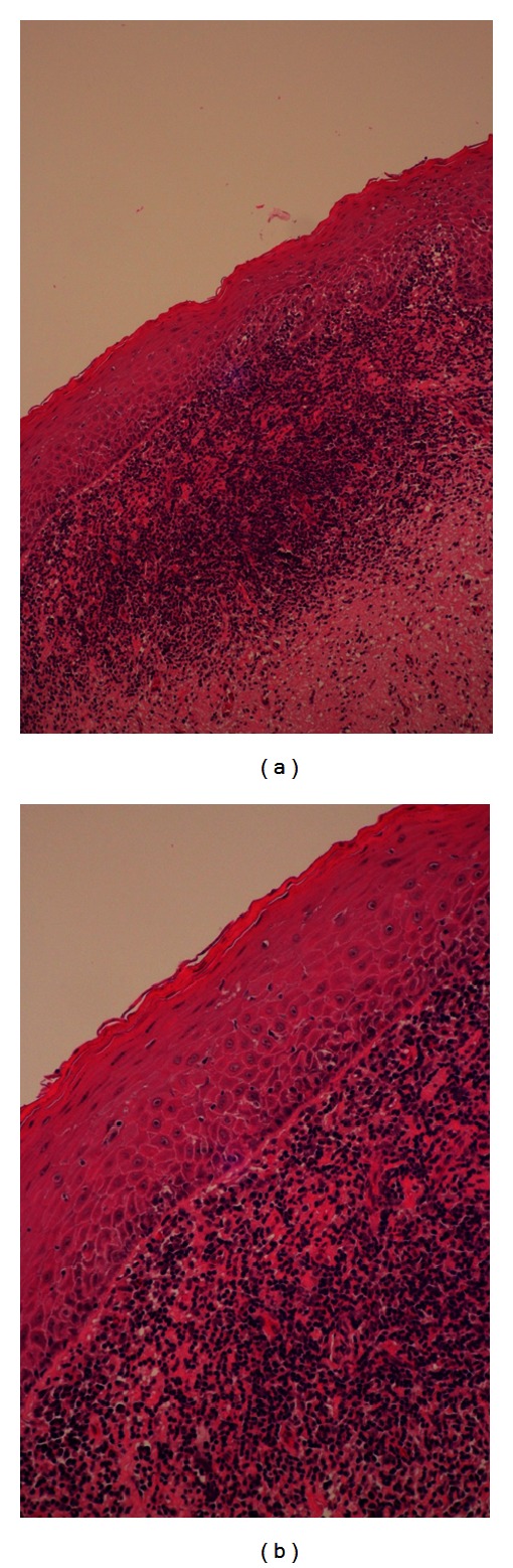 Oral lichen planus in thai patients has a low prevalence of human papillomavirus.