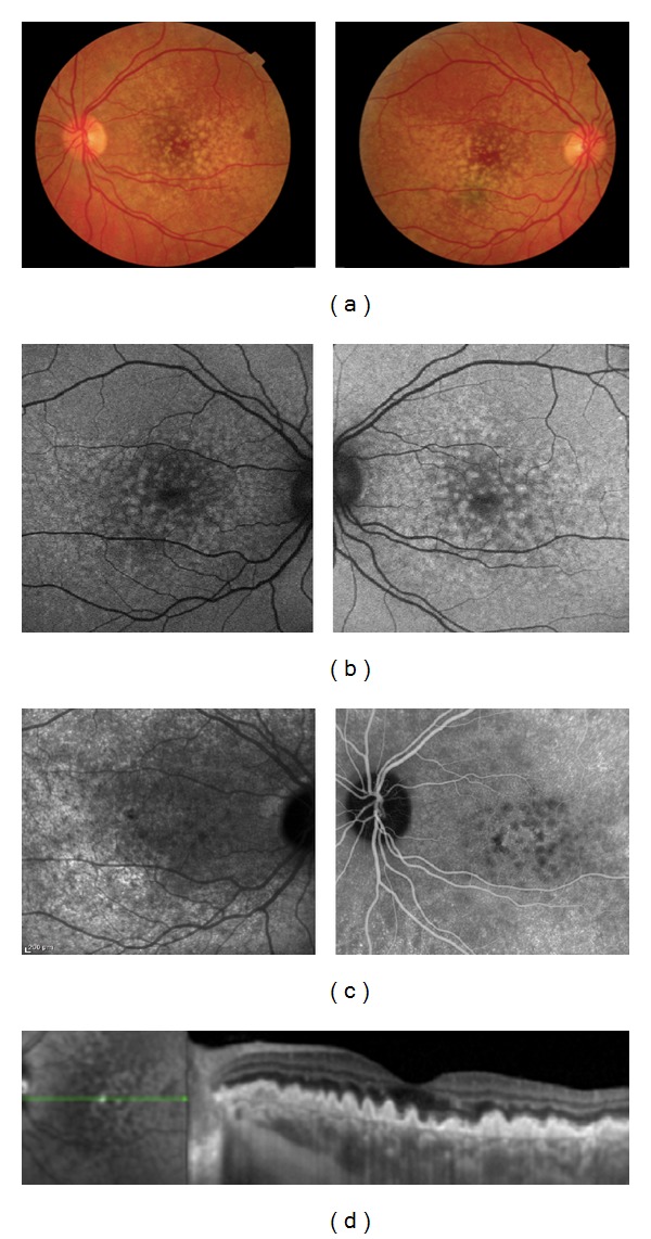 Association of reticular pseudodrusen and early onset drusen.