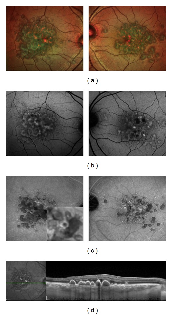 Association of reticular pseudodrusen and early onset drusen.