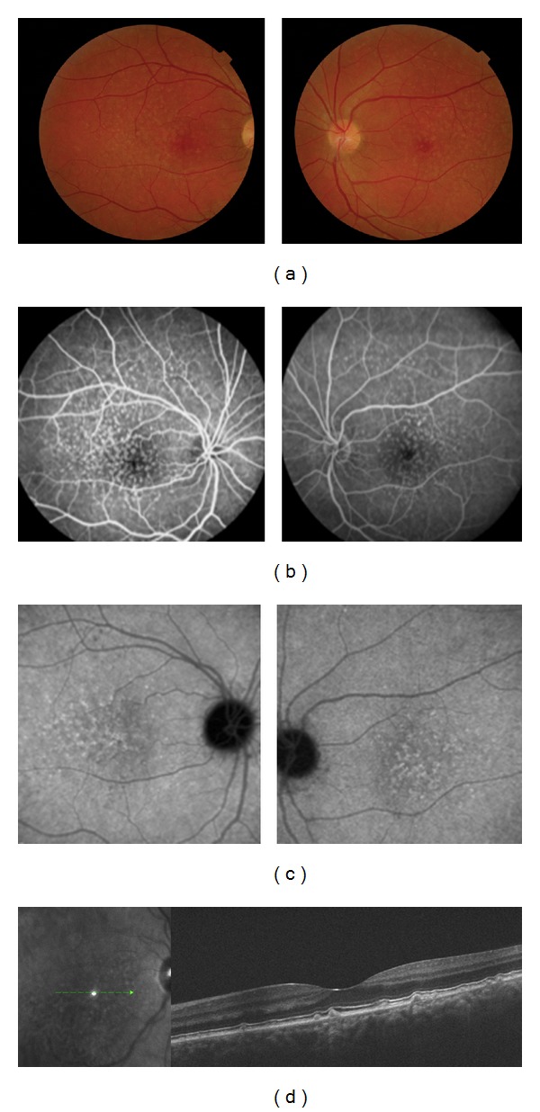 Association of reticular pseudodrusen and early onset drusen.