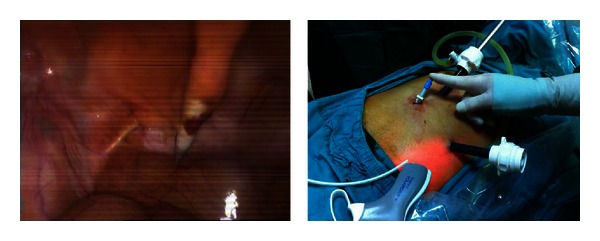 A modified method in laparoscopic peritoneal catheter implantation: the combination of preperitoneal tunneling and pelvic fixation.