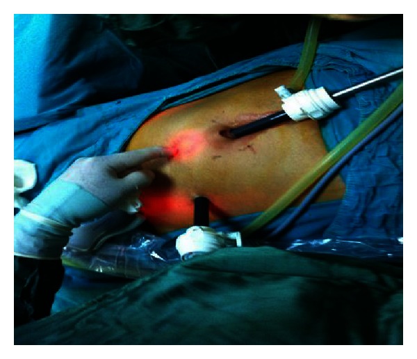 A modified method in laparoscopic peritoneal catheter implantation: the combination of preperitoneal tunneling and pelvic fixation.