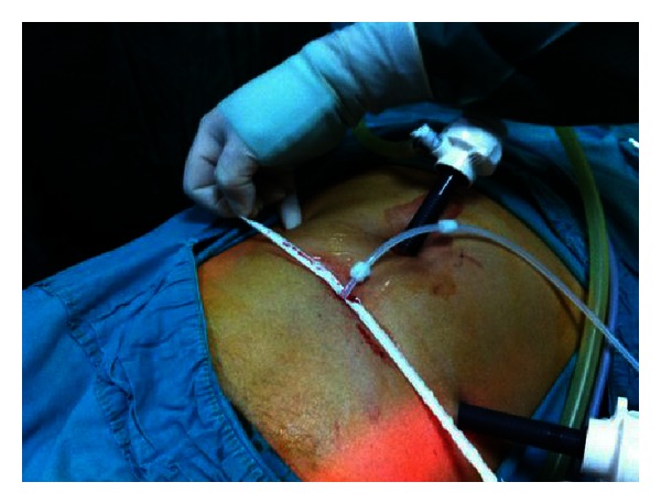 A modified method in laparoscopic peritoneal catheter implantation: the combination of preperitoneal tunneling and pelvic fixation.