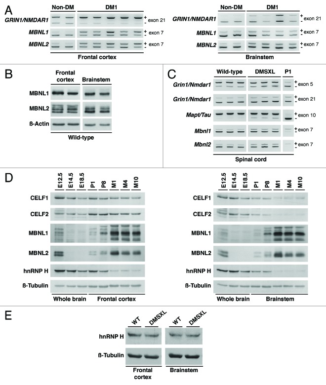 Synaptic protein dysregulation in myotonic dystrophy type 1: Disease neuropathogenesis beyond missplicing.