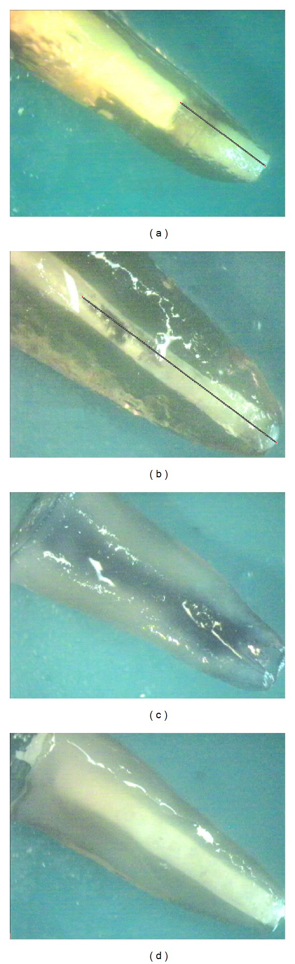 Evaluation of Apical Microleakage in Open Apex Teeth Using MTA Apical Plug in Different Sessions.