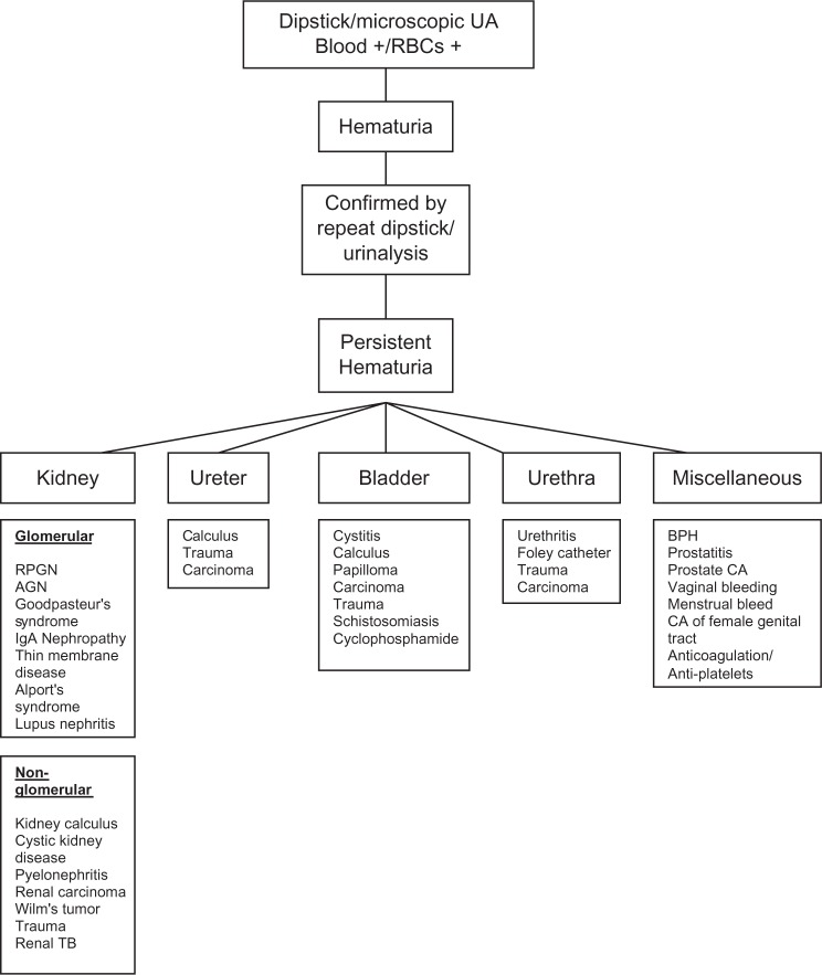 Hemoglobinuria misidentified as hematuria: review of discolored urine and paroxysmal nocturnal hemoglobinuria.