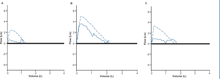 Spirometry in children.