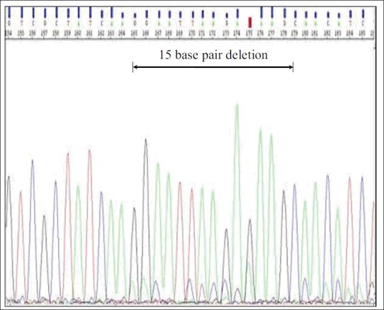 Epidermal growth factor receptor mutation in lung adenocarcinoma in India: A single center study.