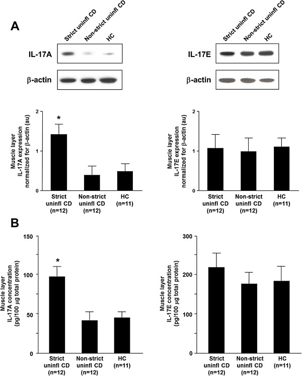 The role of interleukin 17 in Crohn's disease-associated intestinal fibrosis.