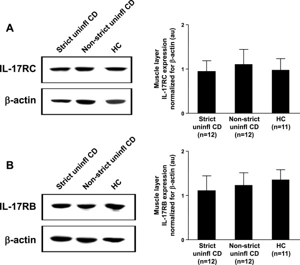 The role of interleukin 17 in Crohn's disease-associated intestinal fibrosis.