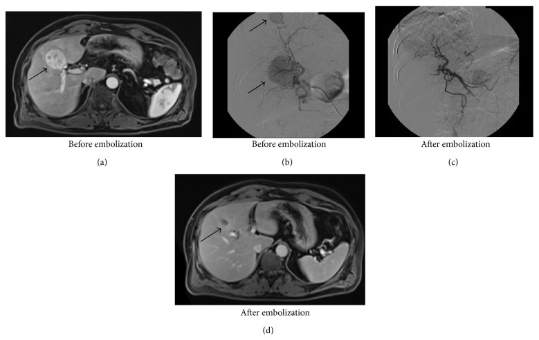 Selective Arterial Embolization of Liver Metastases from Gastrinomas: A Single-Centre Experience.