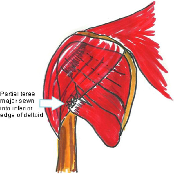 Reoperation for failed shoulder reconstruction following brachial plexus birth injury.