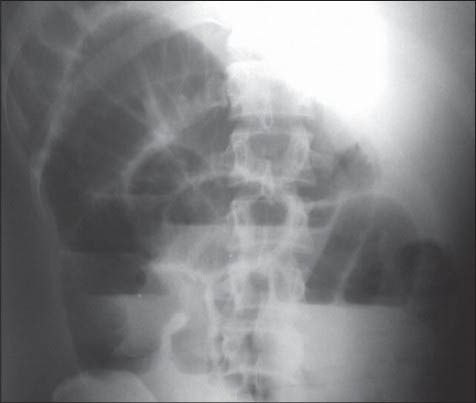 Axial Torsion of Gangrenous Meckel's Diverticulum Causing Small Bowel Obstruction.