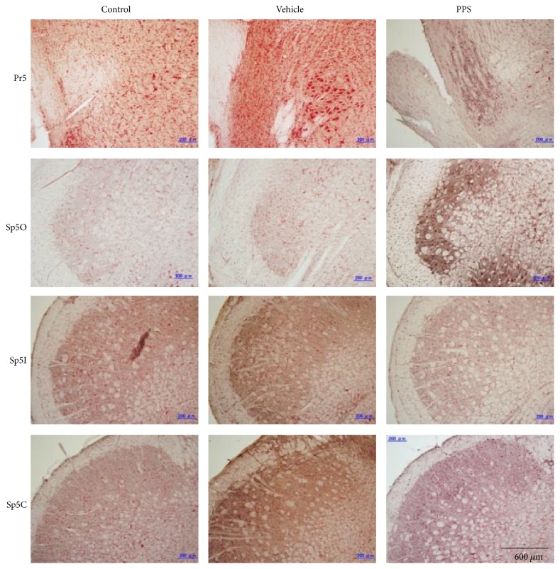 Neural Mechanisms That Underlie Angina-Induced Referred Pain in the Trigeminal Nerve Territory: A c-Fos Study in Rats.