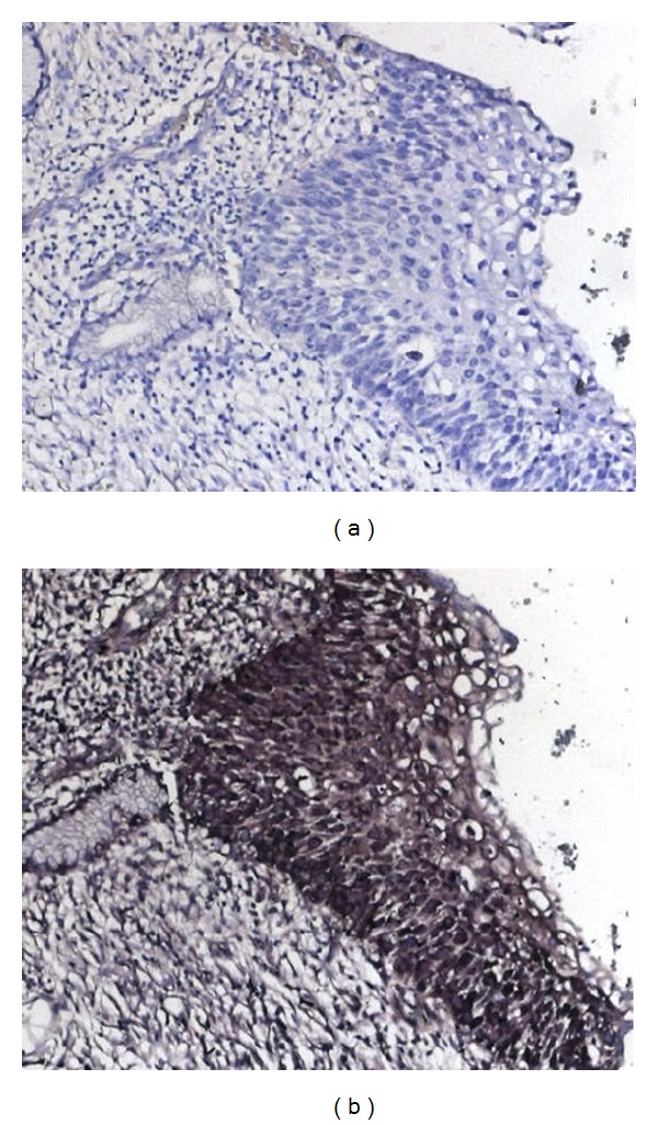 Expression of the h19 oncofetal gene in premalignant lesions of cervical cancer: a potential targeting approach for development of nonsurgical treatment of high-risk lesions.