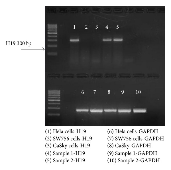 Expression of the h19 oncofetal gene in premalignant lesions of cervical cancer: a potential targeting approach for development of nonsurgical treatment of high-risk lesions.