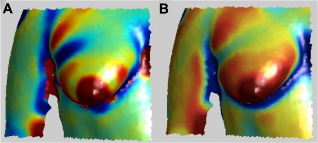 Automated Identification of Fiducial Points on 3D Torso Images.