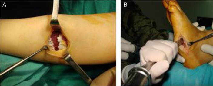 Conservative and surgical treatment of the chronic Charcot foot and ankle.