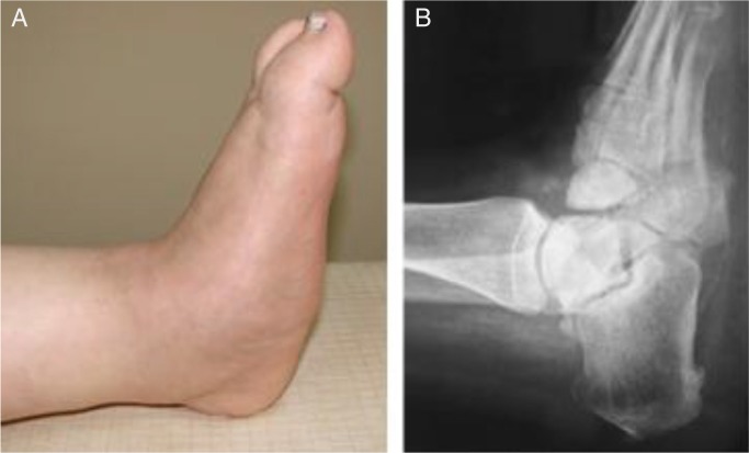 Conservative and surgical treatment of the chronic Charcot foot and ankle.