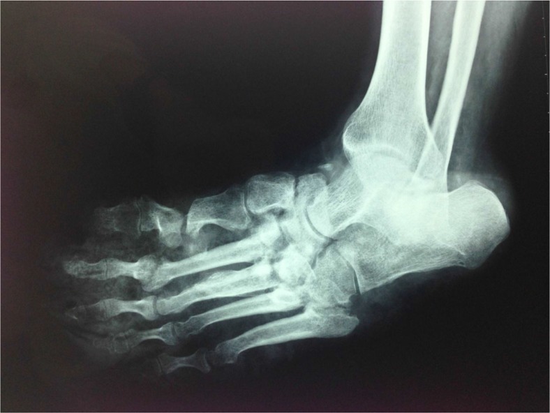 An overview of the Charcot foot pathophysiology.