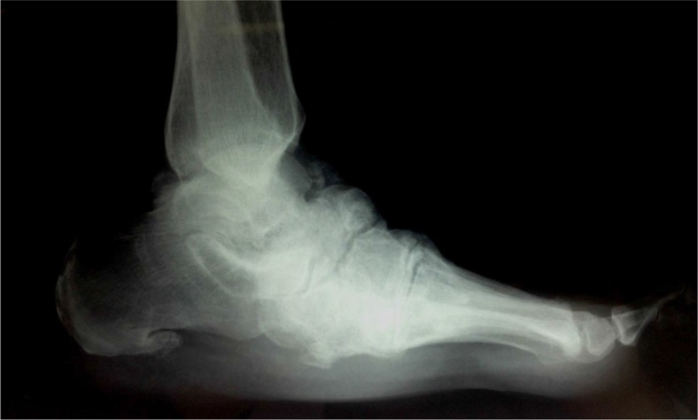 An overview of the Charcot foot pathophysiology.