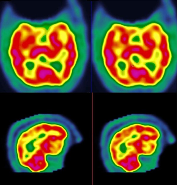 Memory loss during lenalidomide treatment: a report on two cases.