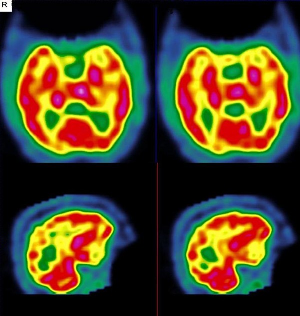 Memory loss during lenalidomide treatment: a report on two cases.