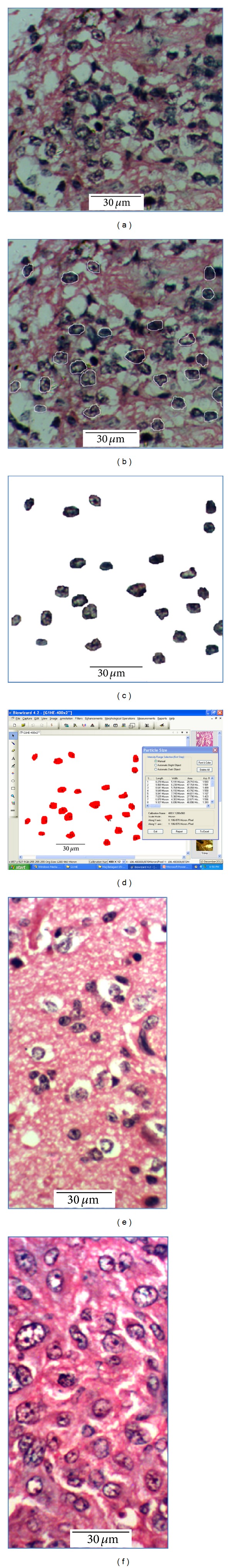 Utility of nuclear morphometry in predicting grades of diffusely infiltrating gliomas.