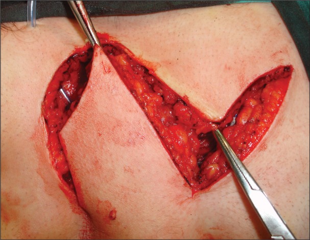 Comparision of the Limberg flap with the V-Y flap technique in the treatment of pilonidal disease.