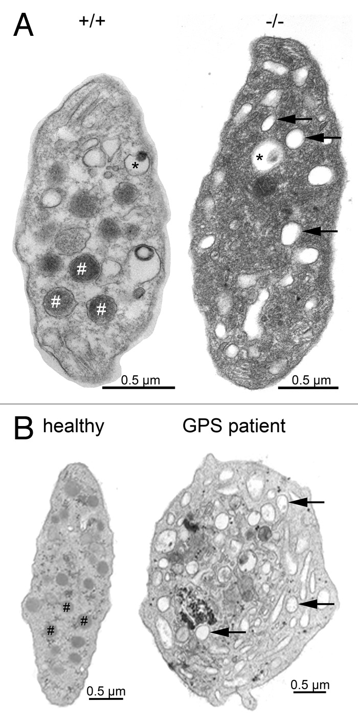 The Nbeal2(-/-) mouse as a model for the gray platelet syndrome.