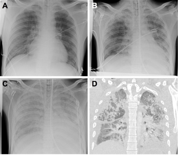 Tissue concentration of paraquat on day 32 after intoxication and failed bridge to transplantation by extracorporeal membrane oxygenation therapy.