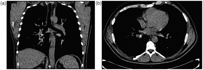 Right lower lobectomy following inhalation of a toy traffic cone.