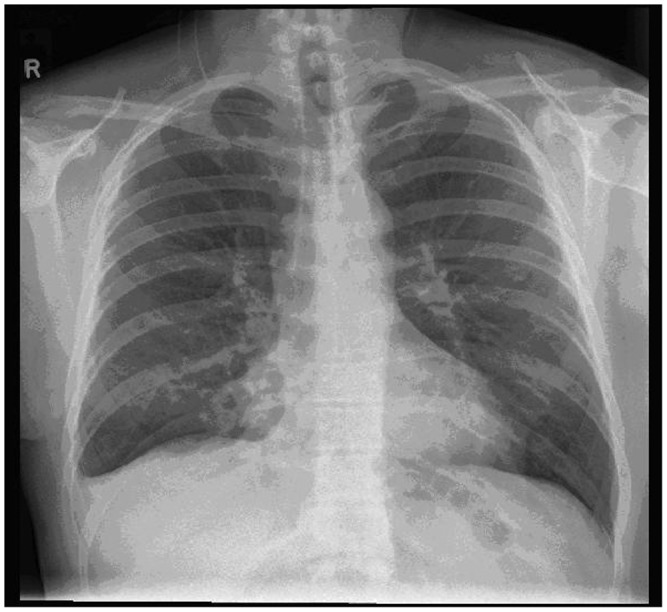 Right lower lobectomy following inhalation of a toy traffic cone.